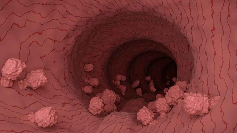 FDA Approval of AMVUTTRA for ATTR Amyloidosis