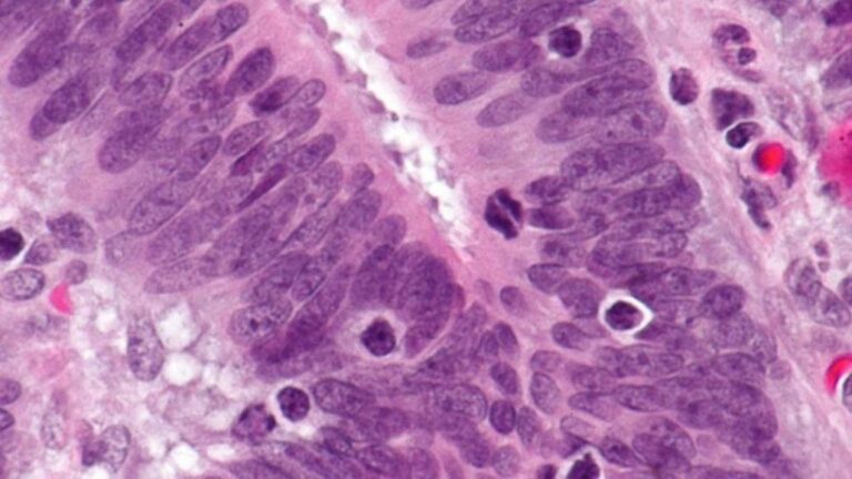 Bevacizumab to be Used by NHS for Colorectal Cancer